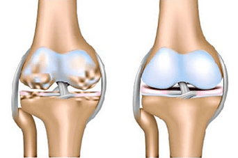 Articulation saine et arthrose