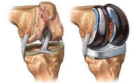 Articulation du genou endoprothétique pour l'arthrose