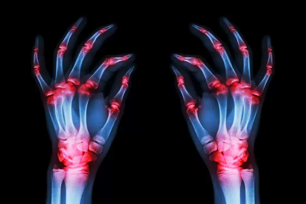 arthrose des articulations des doigts