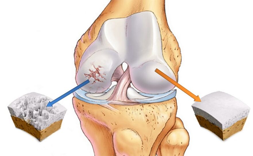 Articulation du genou saine (à droite) et atteinte d'arthrose (à gauche)