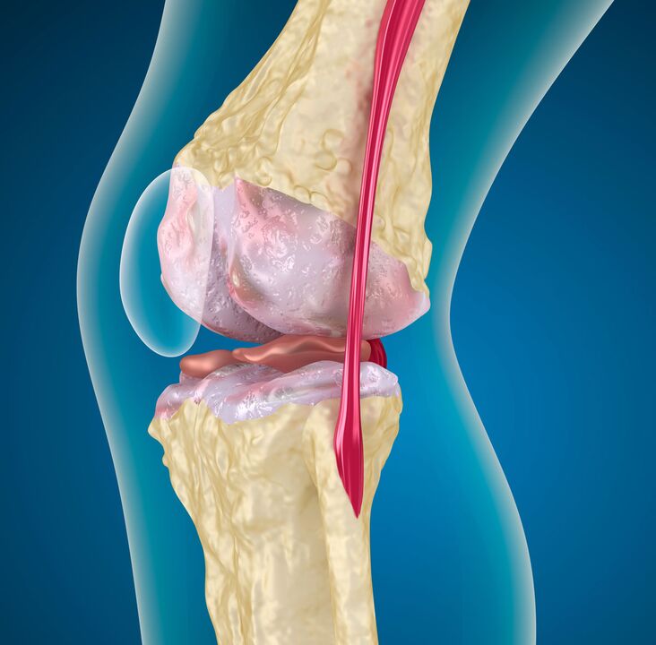 L'arthrose de l'articulation du genou une maladie dystrophique dégénérative
