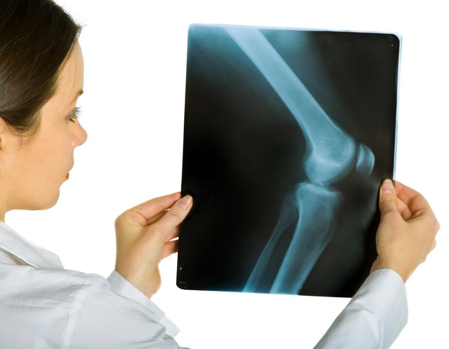 La radiographie de l'articulation du genou révélera la présence d'arthrose déformante. 